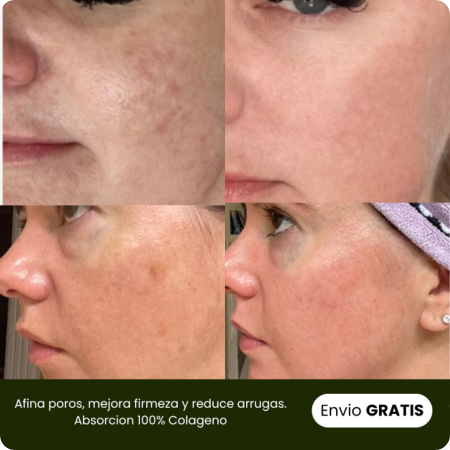 Naturaful™ | Pack Parches de colágeno hidrolizados + Rutina Skincare (GRATIS)